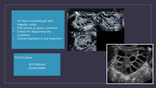 PCOS Criteria
ROTTERDAM
ESHRE/ASRM
• 24 Years unmarried girl with
irregular cycles
• USG picture as given, comment
• Criteria for diagnosing this
condition
• Clinical implications and treatment
 