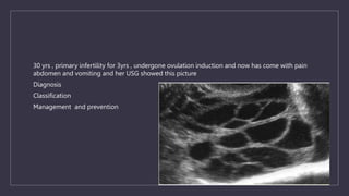 30 yrs , primary infertility for 3yrs , undergone ovulation induction and now has come with pain
abdomen and vomiting and her USG showed this picture
Diagnosis
Classification
Management and prevention
 