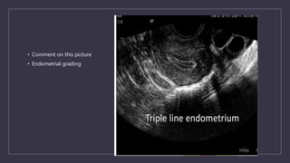 • Comment on this picture
• Endometrial grading
 