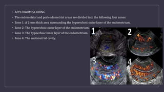 • APPLEBAUM SCORING
• The endometrial and periendometrial areas are divided into the following four zones
• Zone 1: A 2-mm thick area surrounding the hyperechoic outer layer of the endometrium.
• Zone 2: The hyperechoic outer layer of the endometrium.
• Zone 3: The hypoechoic inner layer of the endometrium.
• Zone 4: The endometrial cavity.
 