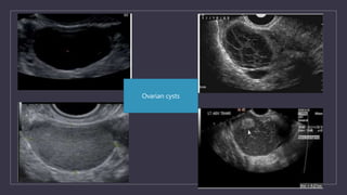 Ovarian cysts
 