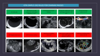 IOTA SIMPLE USG RULES FOR OVARIAN MASSES
 