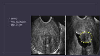 • Identify
• FIGO classification
• STEP-W….???
 