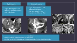 • Angle of divergence: <75
• External contour normal or
mild indentation
• Angle of divergence >105
• Indentation>10mm
• Intervening cleft >1cm
• Intercornual distance >5cm
Bicornuate uterus
Septate uterus
Limitation
• External uterine contour cannot be evaluated
• In cases of non-communicating rudimentary uterine horn may be missed.
 