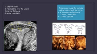 1- interostial line
2- Parallel line over the fundus
3-uterine thickness
4-septal indentation
Troiano and mccarthy formula
A line joining both the horns
• If it cosses the fundus or
<5mm- bicornuate
• >5mm- septate
 
