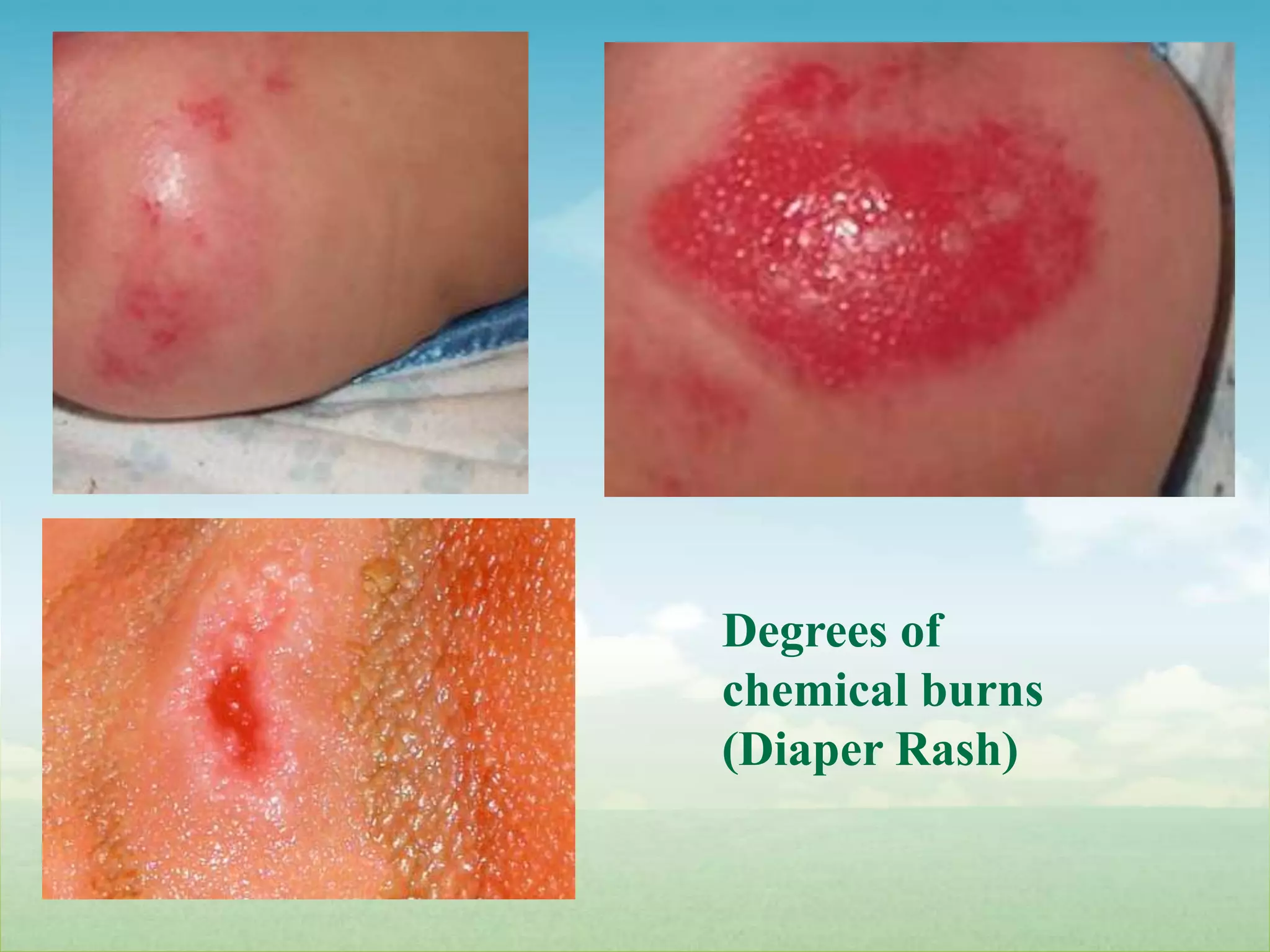 Degrees of chemical burns (Diaper Rash)