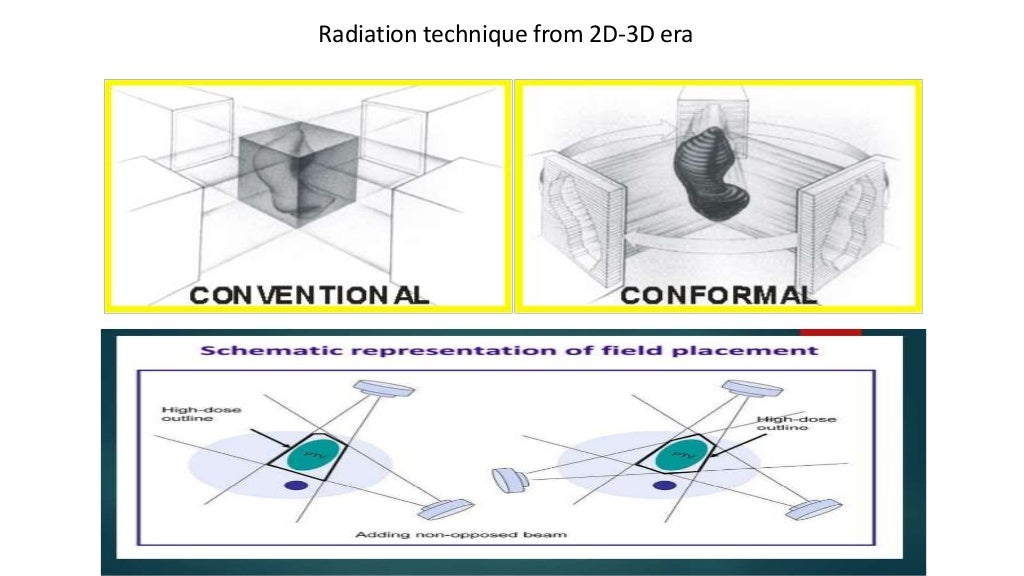 Photon Vs proton beam therapy