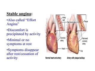 Stable angina:
•Also called “Effort
Angina”
•Discomfort is
precipitated by activity
•Minimal or no
symptoms at rest
•Symptoms disappear
after rest/cessation of
activity
 