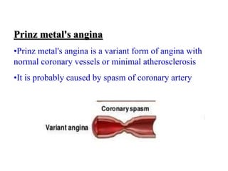 Prinz metal's angina
•Prinz metal's angina is a variant form of angina with
normal coronary vessels or minimal atherosclerosis
•It is probably caused by spasm of coronary artery
 