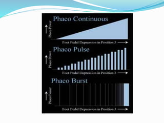 Phaco | PPTX