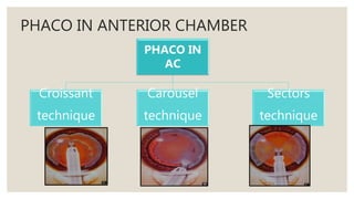 PHACO IN ANTERIOR CHAMBER
PHACO IN
AC
Croissant
technique
Carousel
technique
Sectors
technique
 