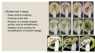 ◦ Divided into 4 steps:
◦ Deep central sculpting.
◦ Fracture of the disc.
◦ Rupture of a wedge shaped
section and its emulsification.
◦ Rotation of the nucleus for
emulsification of another wedge.
 
