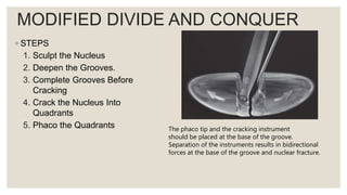 MODIFIED DIVIDE AND CONQUER
◦ STEPS
1. Sculpt the Nucleus
2. Deepen the Grooves.
3. Complete Grooves Before
Cracking
4. Crack the Nucleus Into
Quadrants
5. Phaco the Quadrants The phaco tip and the cracking instrument
should be placed at the base of the groove.
Separation of the instruments results in bidirectional
forces at the base of the groove and nuclear fracture.
 