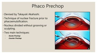 Phaco Prechop
◦ Devised by Takayuki Akahoshi.
◦ Technique of nuclear fracture prior to
phacoemulsification.
◦ Nucleus divided without grooving or
sculpting.
◦ Two main techniques:
◦ Karate Prechop
◦ Counter Prechop
 