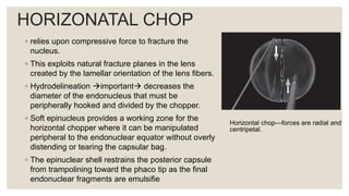 HORIZONATAL CHOP
◦ relies upon compressive force to fracture the
nucleus.
◦ This exploits natural fracture planes in the lens
created by the lamellar orientation of the lens fibers.
◦ Hydrodelineation important decreases the
diameter of the endonucleus that must be
peripherally hooked and divided by the chopper.
◦ Soft epinucleus provides a working zone for the
horizontal chopper where it can be manipulated
peripheral to the endonuclear equator without overly
distending or tearing the capsular bag.
◦ The epinuclear shell restrains the posterior capsule
from trampolining toward the phaco tip as the final
endonuclear fragments are emulsifie
Horizontal chop—forces are radial and
centripetal.
 