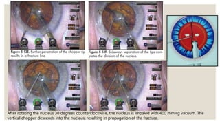 After rotating the nucleus 30 degrees counterclockwise, the nucleus is impaled with 400 mmHg vacuum. The
vertical chopper descends into the nucleus, resulting in propagation of the fracture.
 