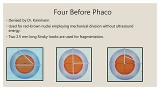 Four Before Phaco
◦ Devised by Dr. Kammann.
◦ Used for red-brown nuclei employing mechanical division without ultrasound
energy.
◦ Two 2.5 mm long Sinsky hooks are used for fragmentation.
 