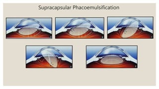 Supracapsular Phacoemulsification
 