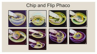 Chip and Flip Phaco
 