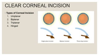CLEAR CORNEAL INCISION
◦ Types of Corneal Incision
1. Uniplanar
2. Biplanar
3. Triplanar
4. Hinged
 