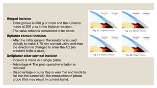 Hinged incision
◦ Initial groove is 600 μ or more and the tunnel is
made at 300 μ as in the triplanar incision.
◦ The valve action is considered to be better.
Biplanar corneal incision
◦ After the initial groove, the keratome is used
directly to make 1.75 mm corneal valve and then
the direction is changed to enter the AC (no
crescent knife is used).
Unilplanar clear corneal incision
◦ Incision is made in a single plane.
◦ Advantage The post-operative irritation is
reduced.
◦ Disadvantage outer flap is very thin and tends to
roll into the tunnel with the introduction of phaco
probe (this may result in corneal burn).
 