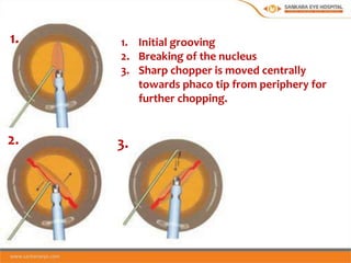 PHACO | PPTX