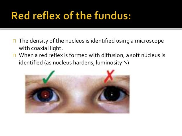phacoemulsification