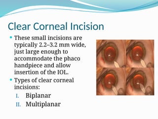 PHACOEMULSIFICATION in Ophthalmology.pptx
