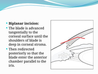 PHACOEMULSIFICATION in Ophthalmology.pptx