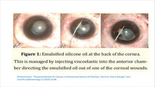 Phacoemulsification in Vitrectomized Silicone Oil Filled Eyes | PDF