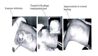 S.aureus infection
Treated with phage
impregnated pad
Improvement in wound
healing
 