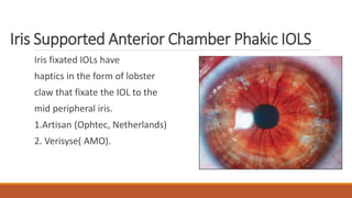 Phakic intraocular lens | PPTX