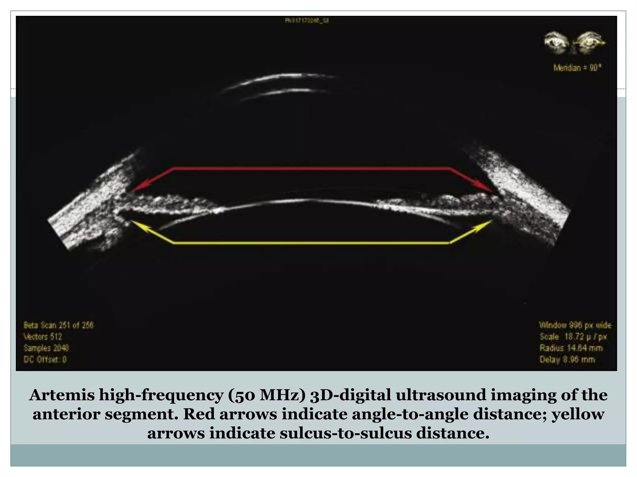 Artemis high-frequency (50 MHz) 3D-digital ultrasound imaging of the
anterior segment. Red arrows indicate angle-to-angle distance; yellow
arrows indicate sulcus-to-sulcus distance.
 