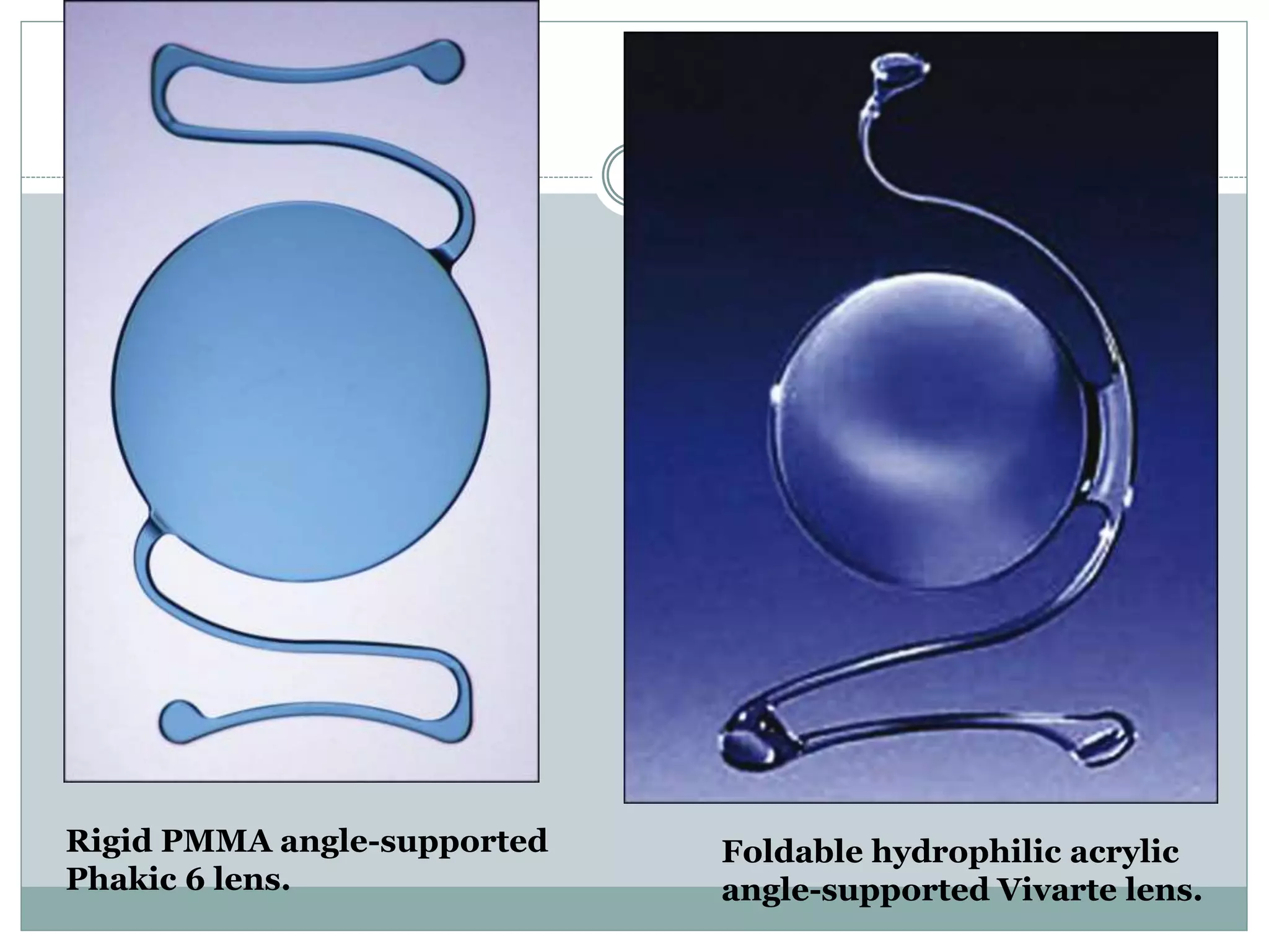 Foldable hydrophilic acrylic
angle-supported Vivarte lens.
Rigid PMMA angle-supported
Phakic 6 lens.
 