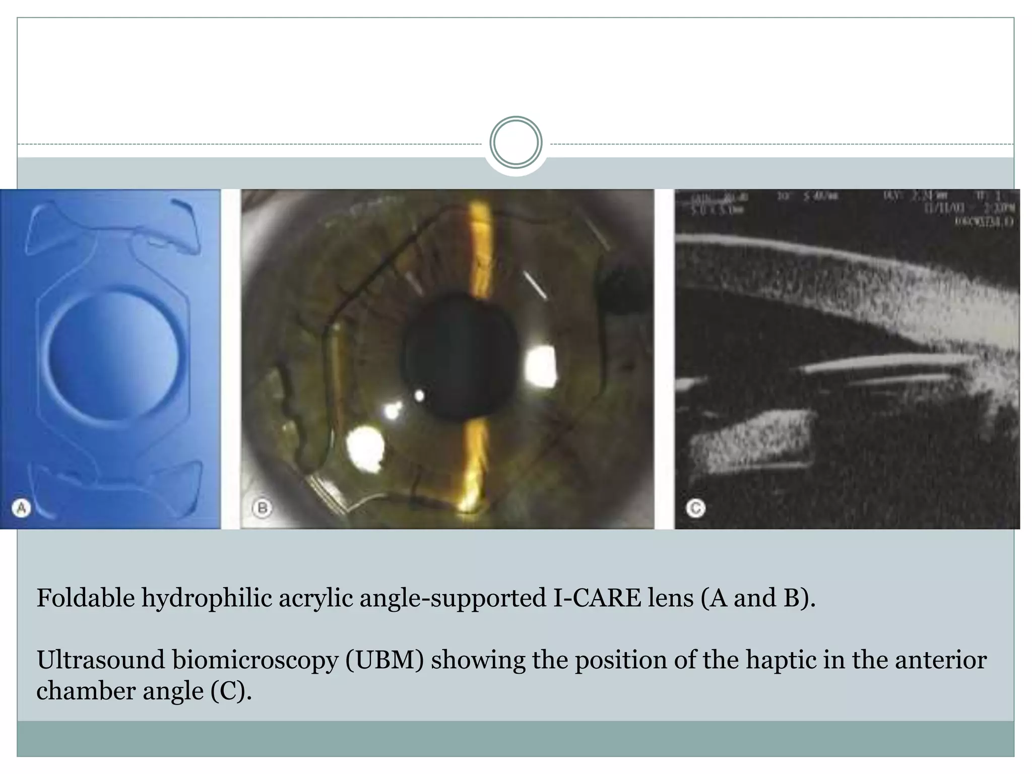 Foldable hydrophilic acrylic angle-supported I-CARE lens (A and B).
Ultrasound biomicroscopy (UBM) showing the position of the haptic in the anterior
chamber angle (C).
 