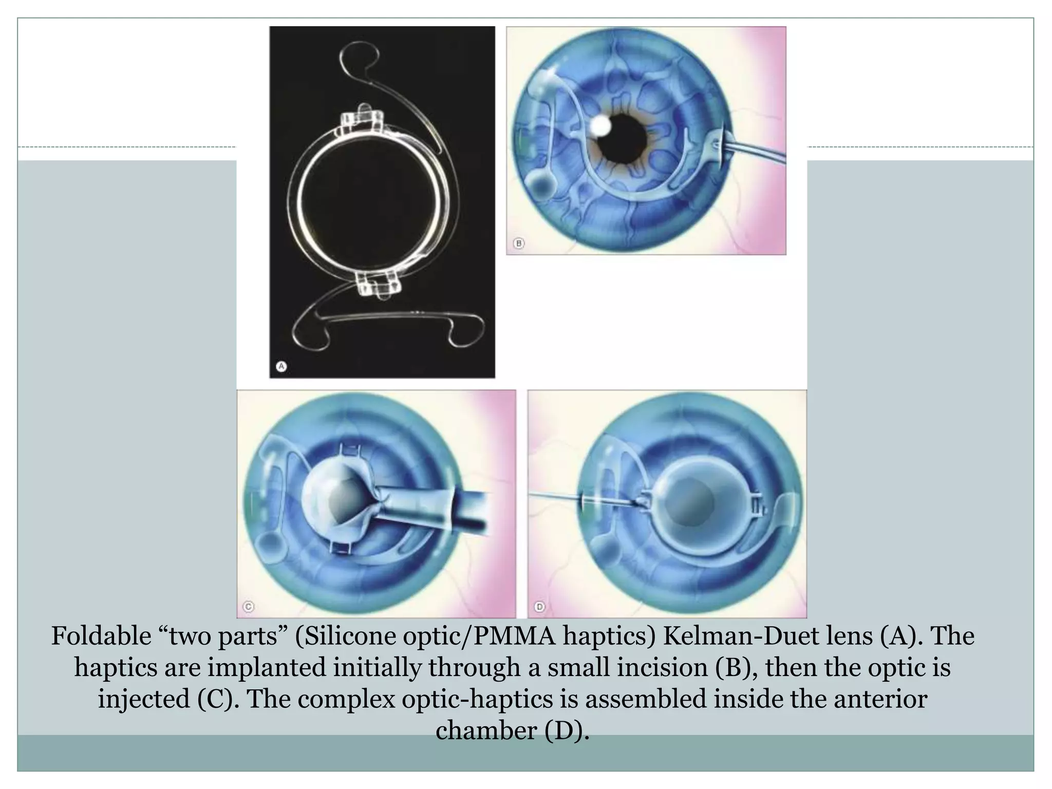 Foldable “two parts” (Silicone optic/PMMA haptics) Kelman-Duet lens (A). The
haptics are implanted initially through a small incision (B), then the optic is
injected (C). The complex optic-haptics is assembled inside the anterior
chamber (D).
 