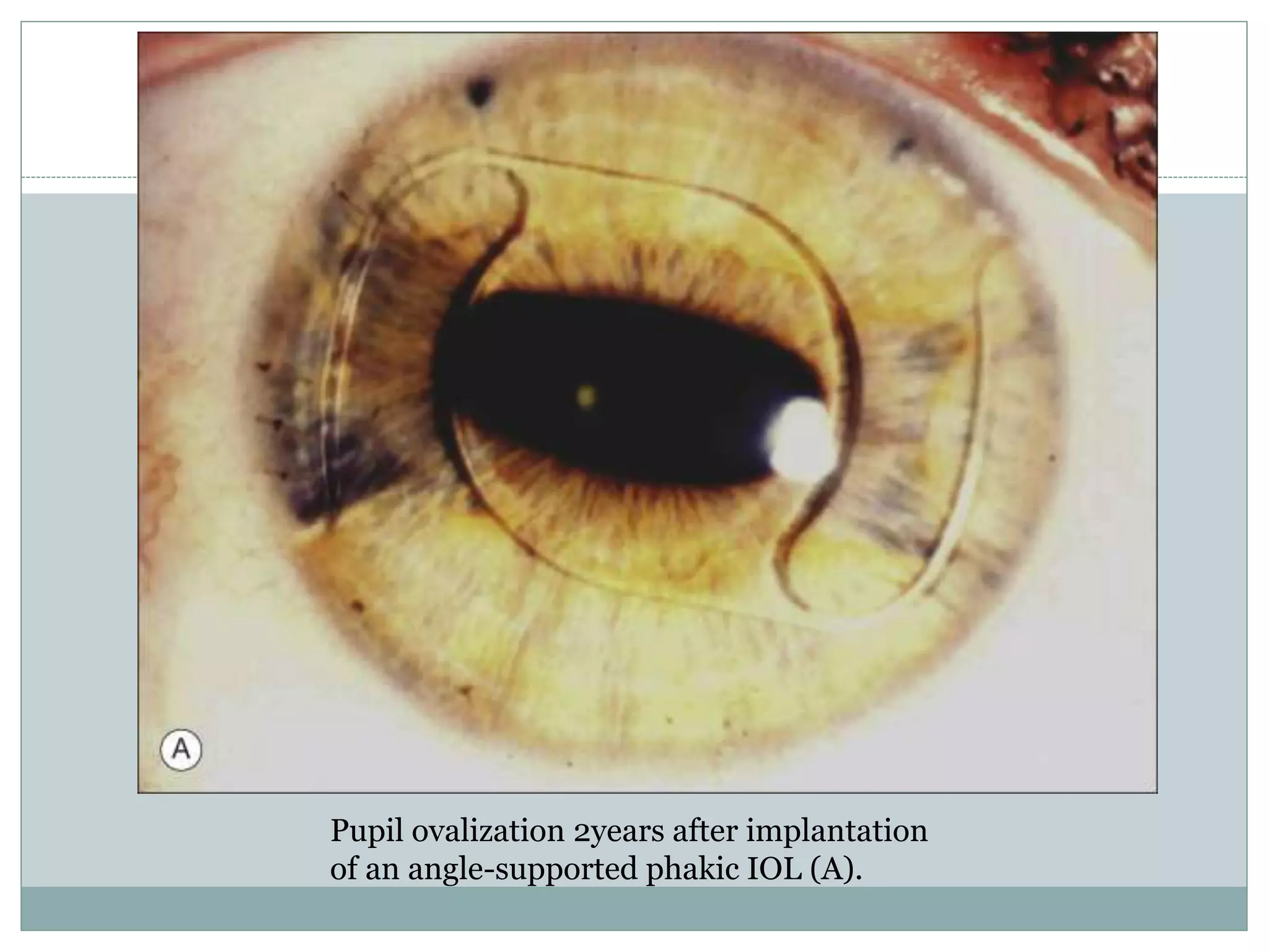 Pupil ovalization 2years after implantation
of an angle-supported phakic IOL (A).
 