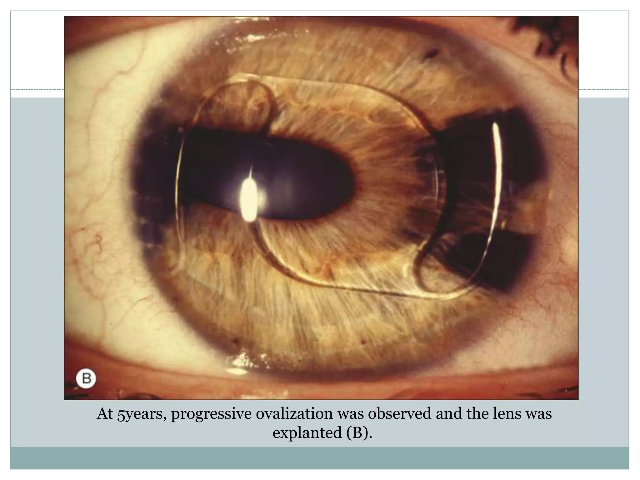 At 5years, progressive ovalization was observed and the lens was
explanted (B).
 