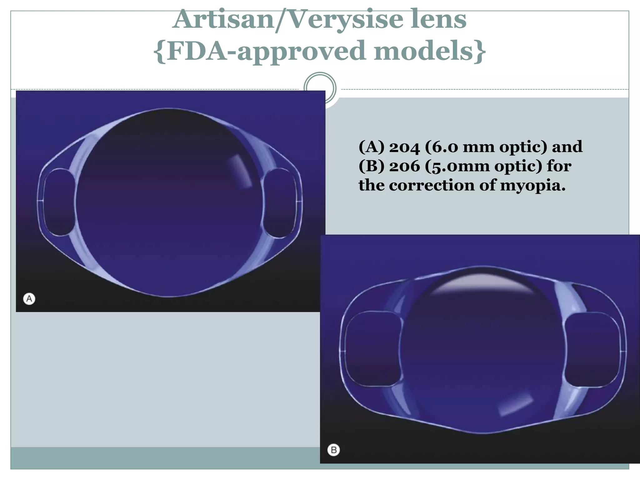 Artisan/Verysise lens
{FDA-approved models}
(A) 204 (6.0 mm optic) and
(B) 206 (5.0mm optic) for
the correction of myopia.
 