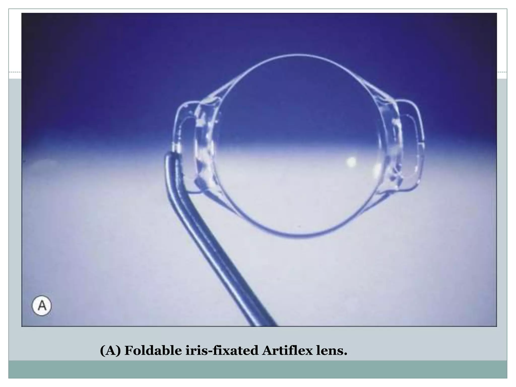 (A) Foldable iris-fixated Artiflex lens.
 