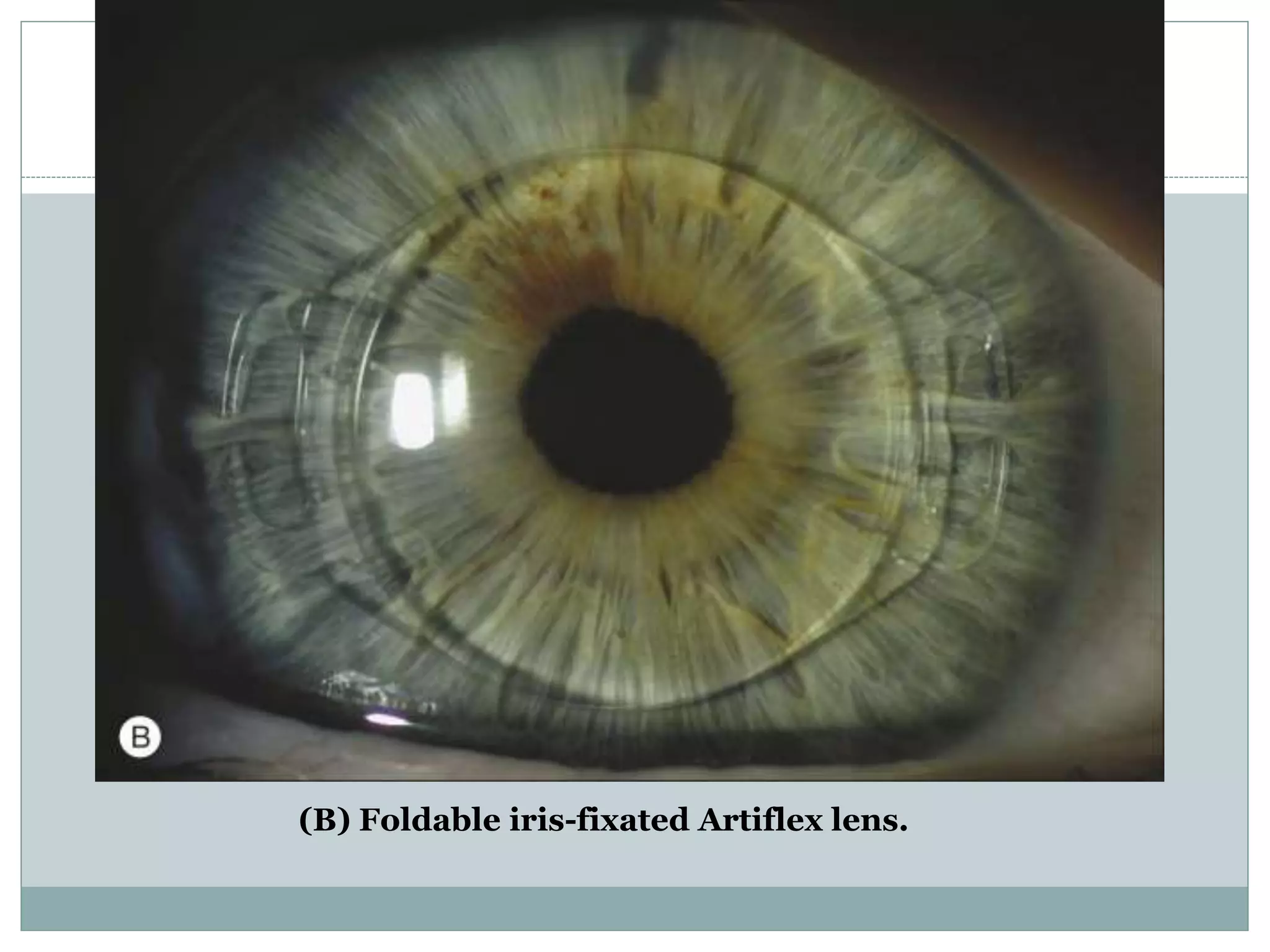 (B) Foldable iris-fixated Artiflex lens.
 