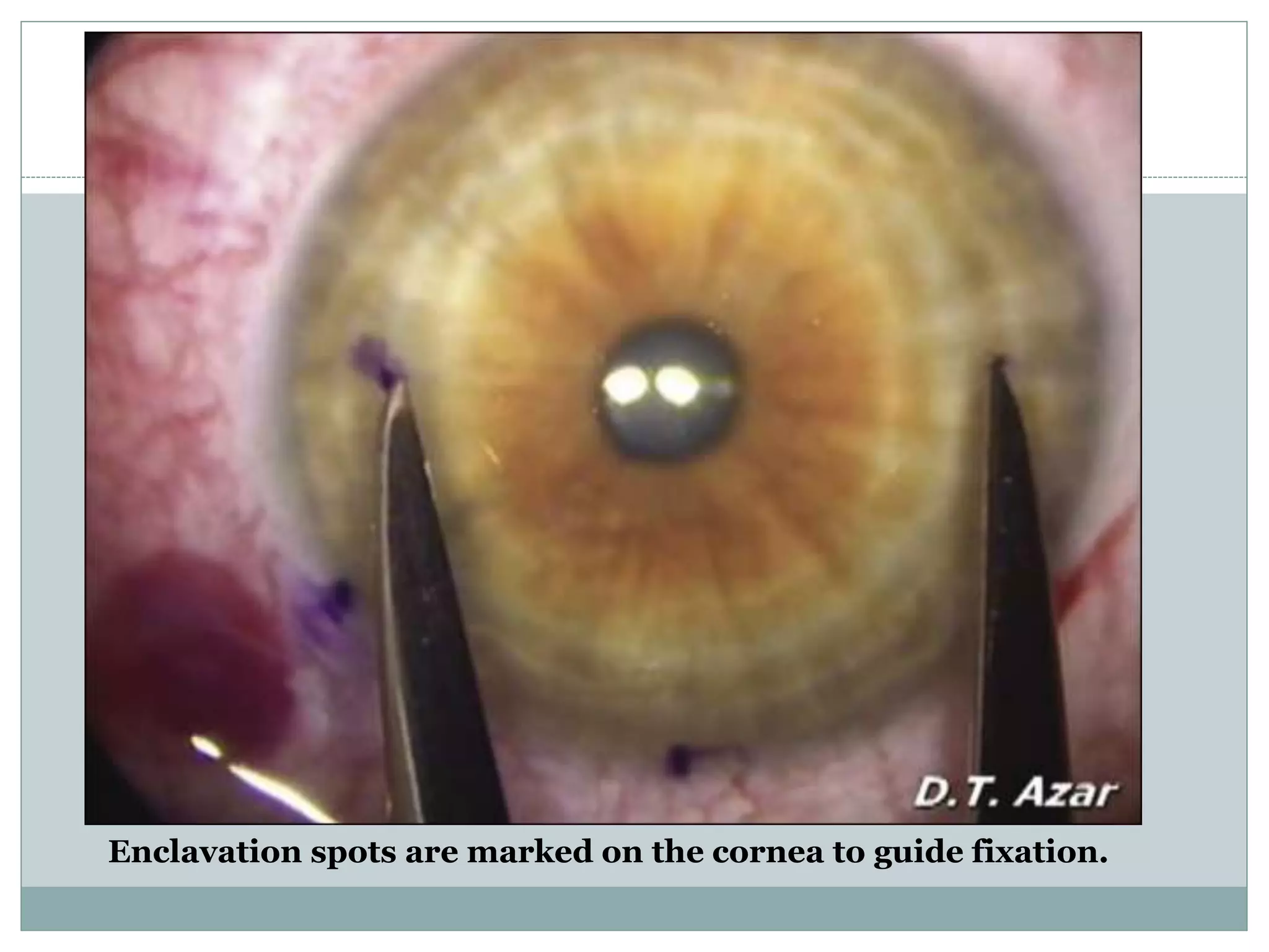 Enclavation spots are marked on the cornea to guide fixation.
 