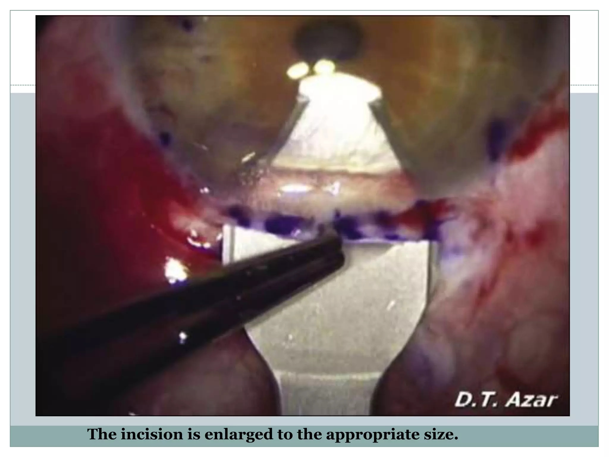 The incision is enlarged to the appropriate size.
 