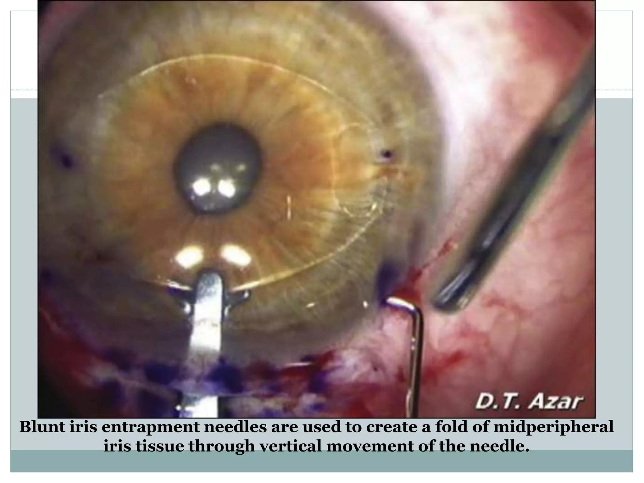 Blunt iris entrapment needles are used to create a fold of midperipheral
iris tissue through vertical movement of the needle.
 