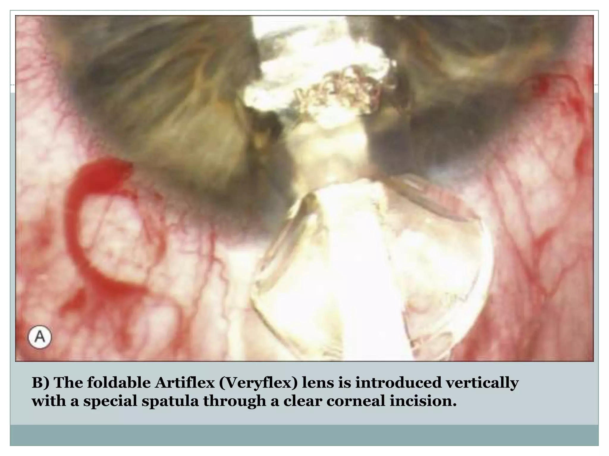 B) The foldable Artiflex (Veryflex) lens is introduced vertically
with a special spatula through a clear corneal incision.
 
