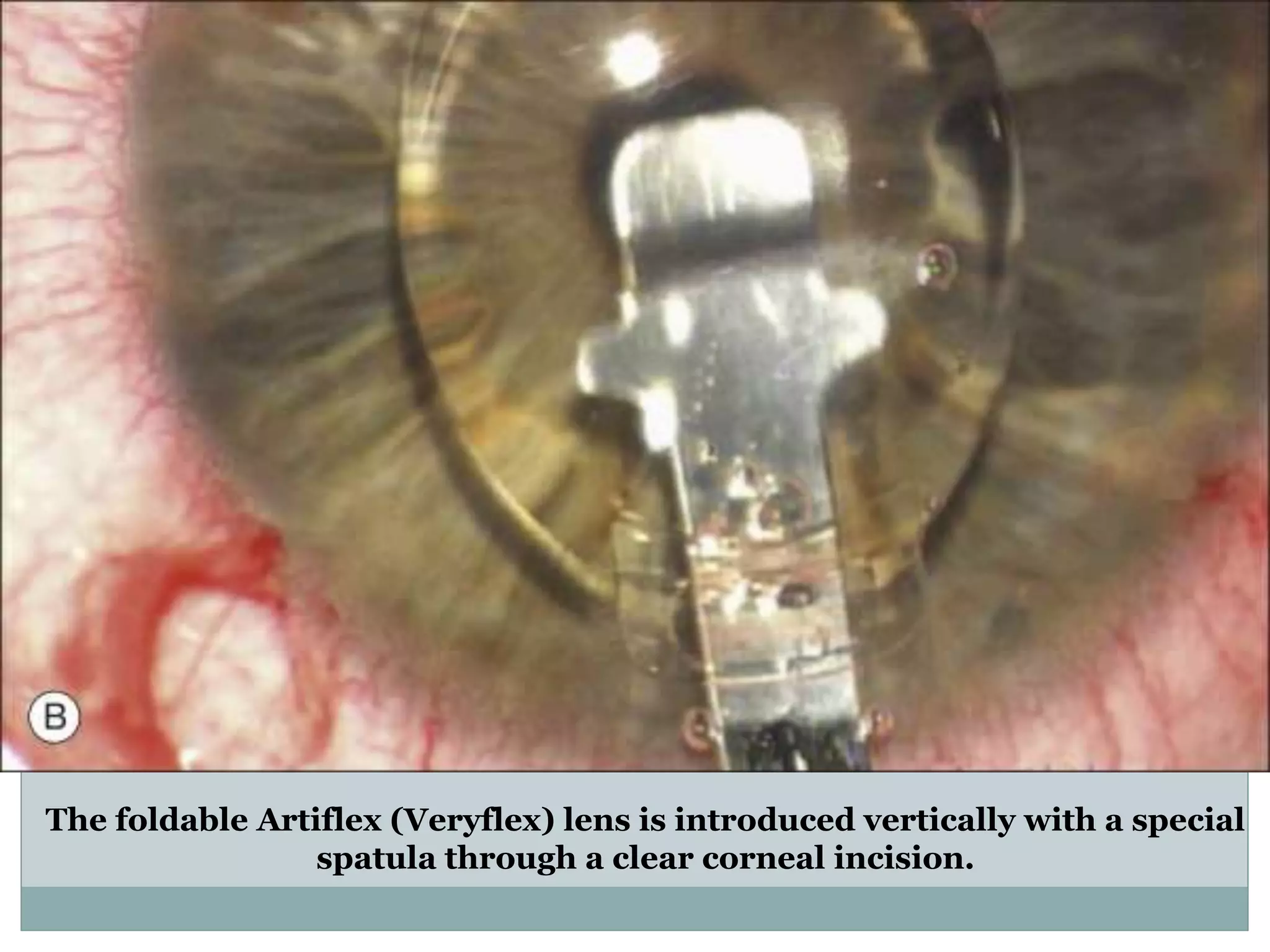 The foldable Artiflex (Veryflex) lens is introduced vertically with a special
spatula through a clear corneal incision.
 