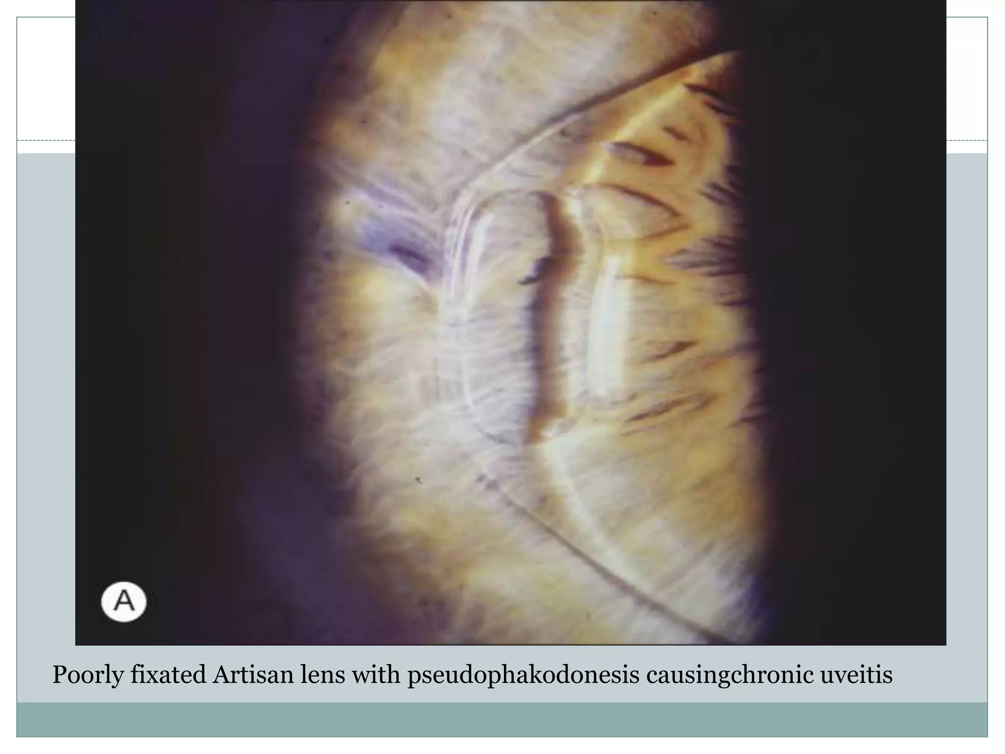 Poorly fixated Artisan lens with pseudophakodonesis causingchronic uveitis
 