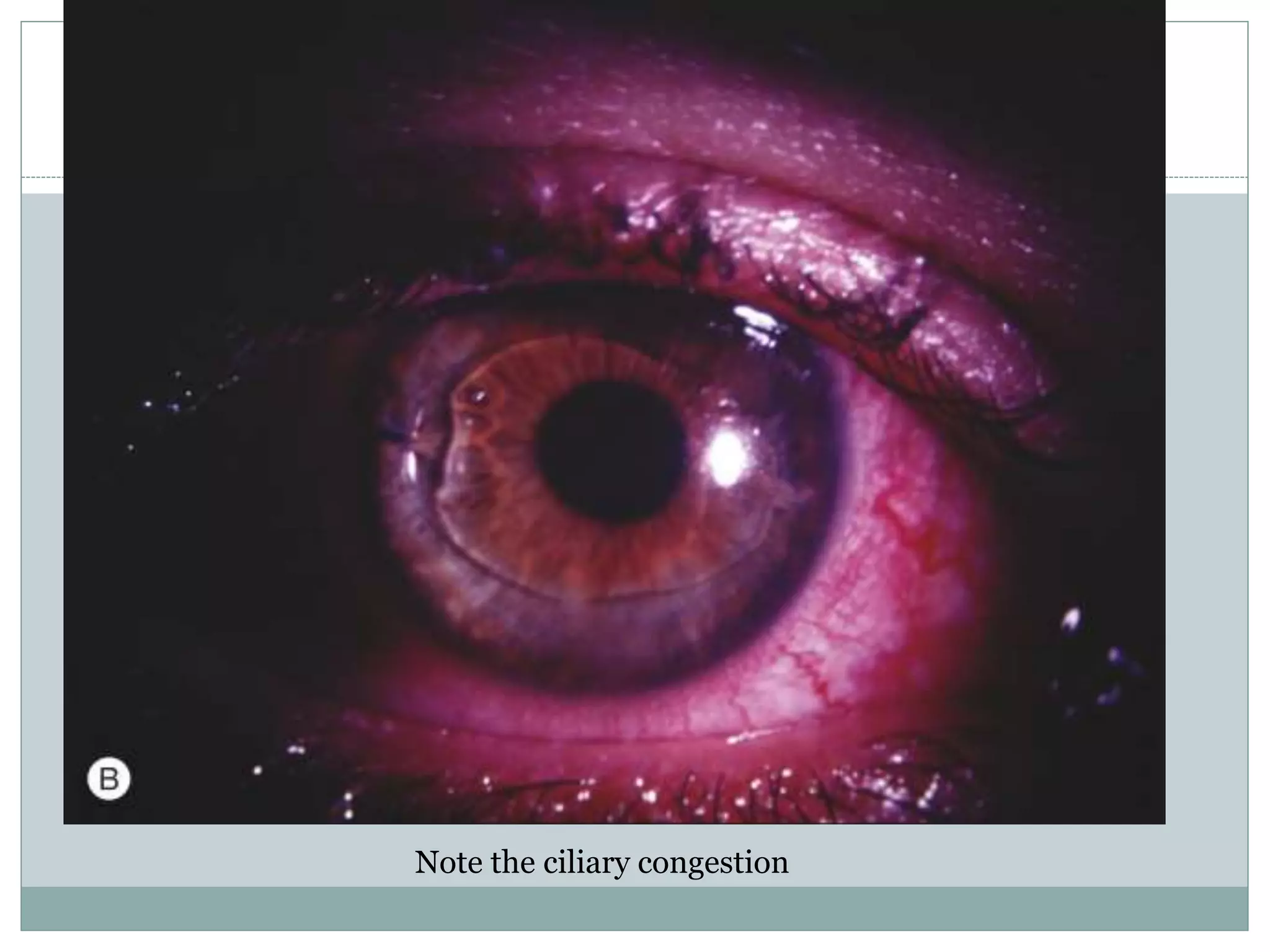 Note the ciliary congestion
 