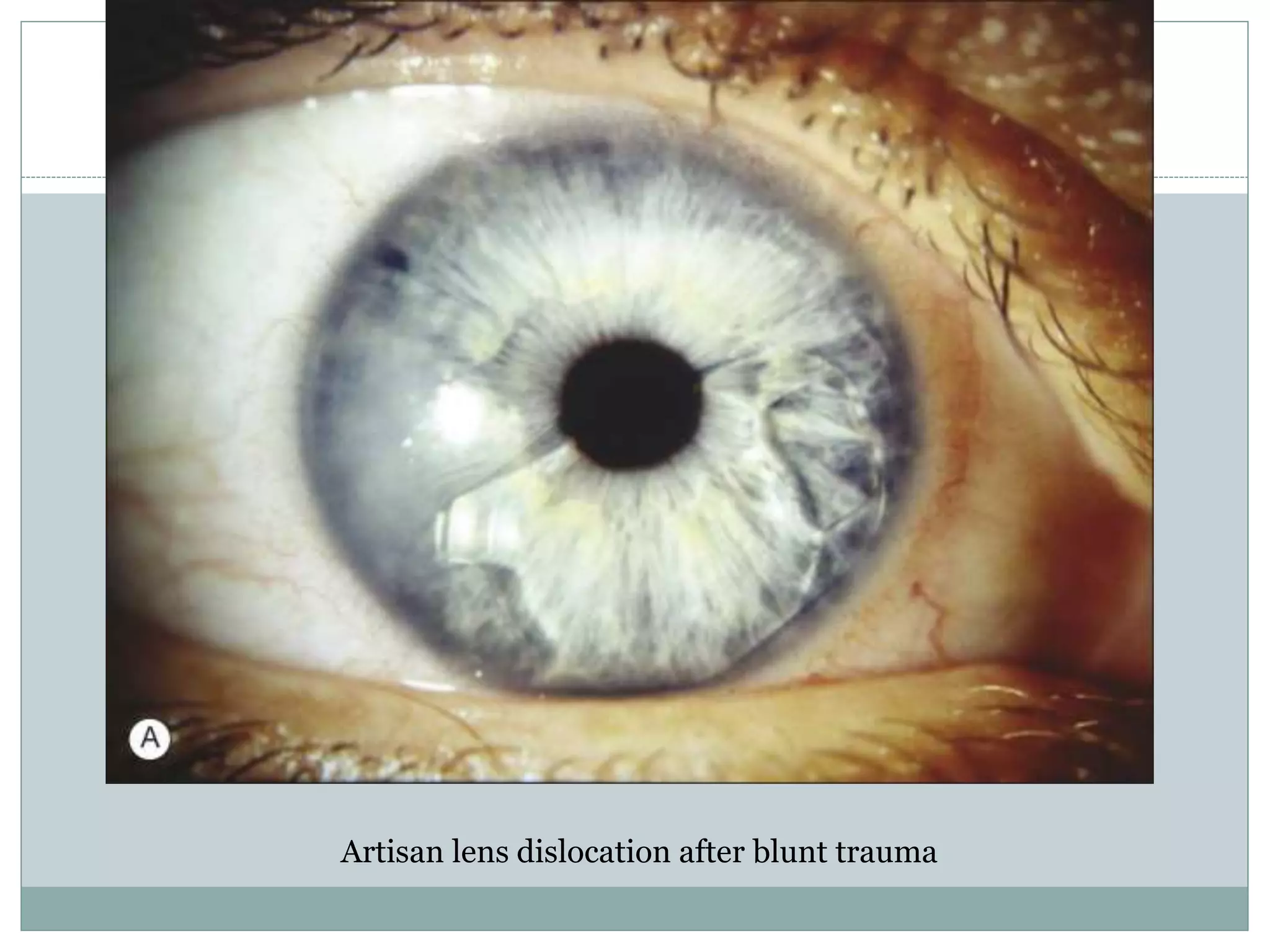 Artisan lens dislocation after blunt trauma
 
