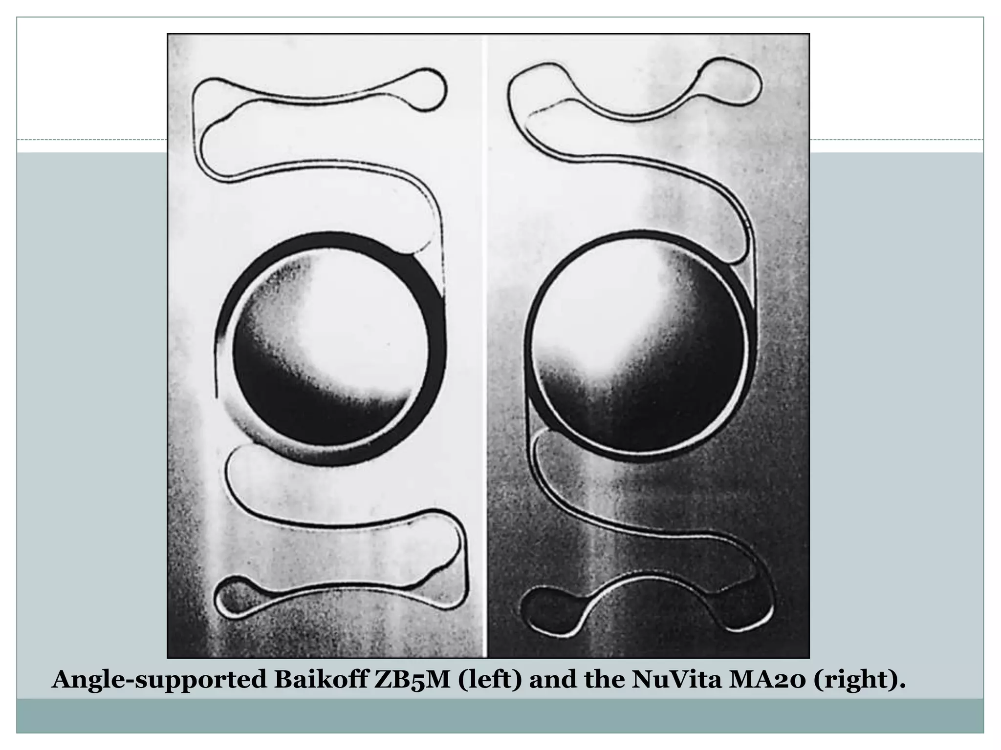 Angle-supported Baikoff ZB5M (left) and the NuVita MA20 (right).
 